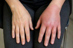 "Mano con inflamación por síndrome de dolor regional complejo"